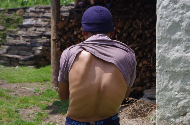 ang-dawa-back-surgery